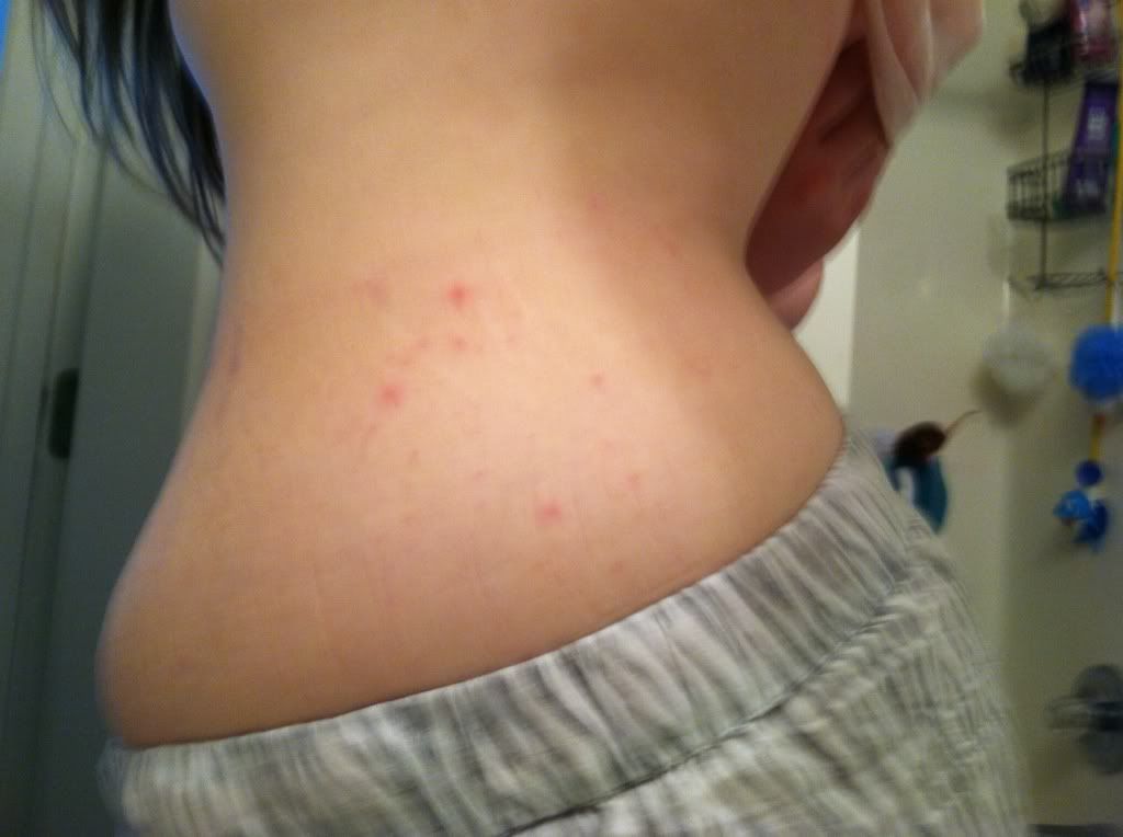 ve already had the chicken pox. Wtf is this!?