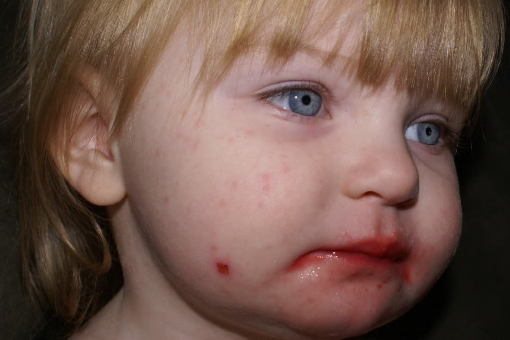 sulfa allergy rash