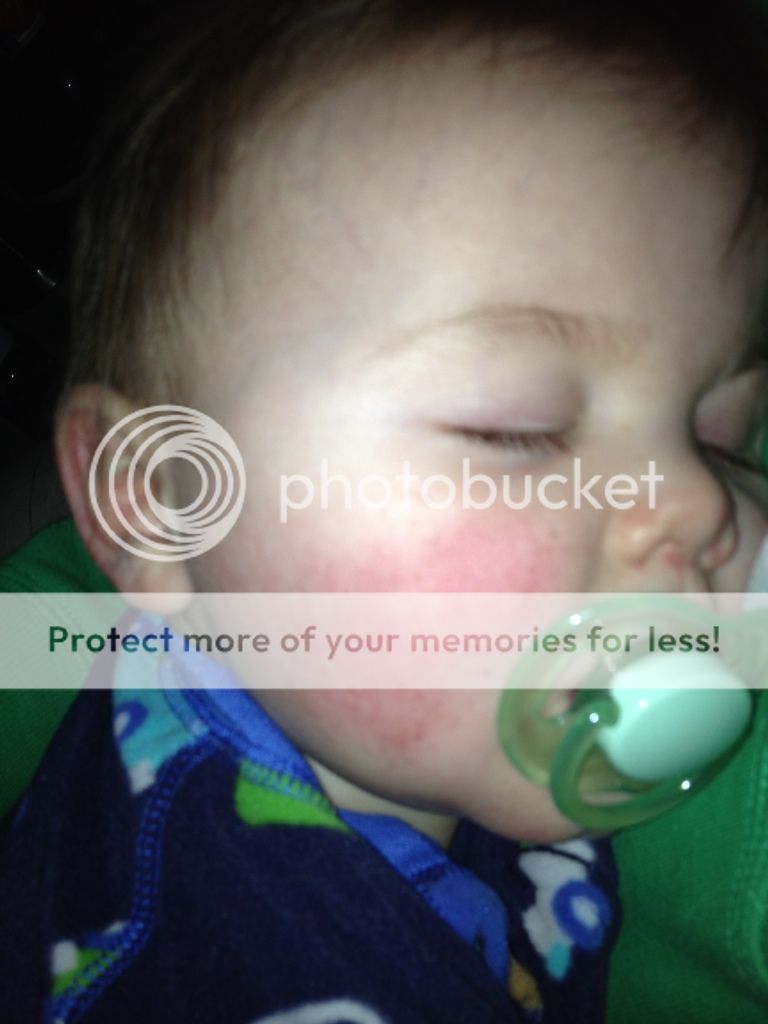 Fifth disease. BabyCenter